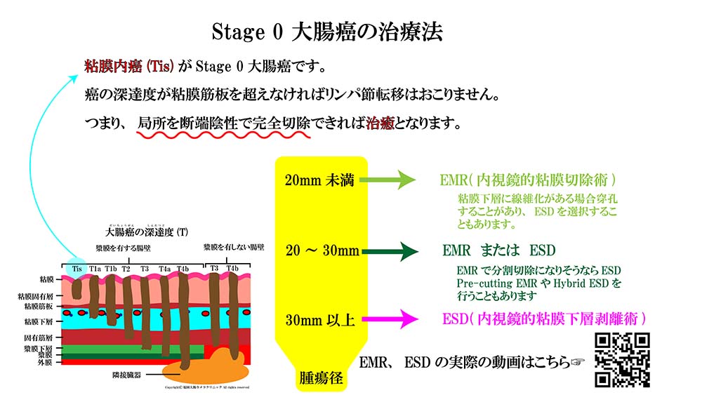 大腸癌の治療法00