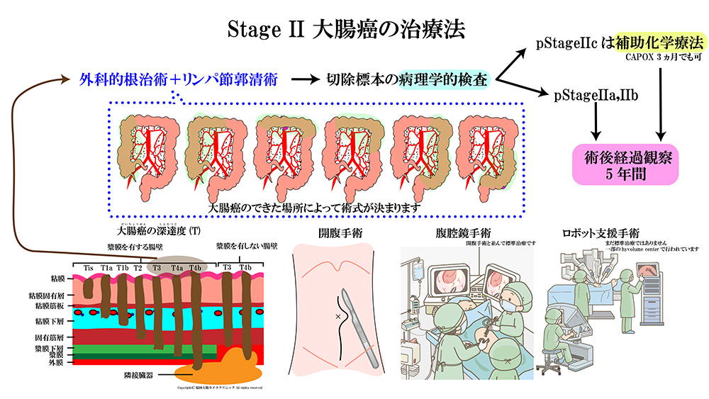 大腸癌の治療法02