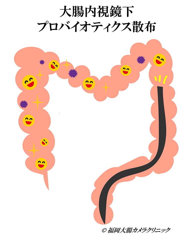 大腸内視鏡下散布02