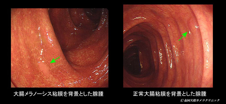 大腸メラノーシスと腺腫性ポリープ