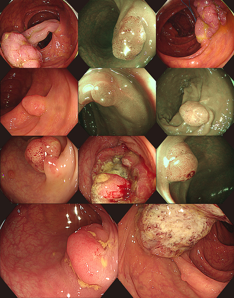 大腸癌の実績例2025年