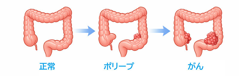 大腸がんの進行